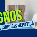 cirrosis hepatica como saber si tengo