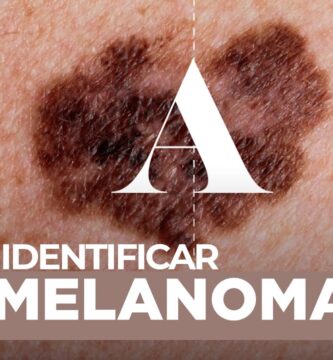 cómo saber si es melanoma