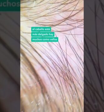 como saber si sufro alopecia