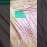 cómo saber si tengo alopecia