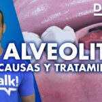 cómo saber si tengo alveolitis