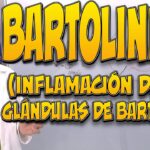 cómo saber si tengo bartolinitis