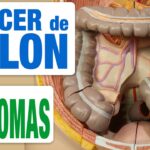 como saber si tengo cancer colon