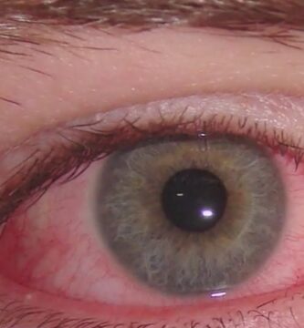 cómo saber si tengo conjuntivitis