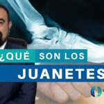 cómo saber si tengo juanetes