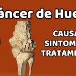 como saber si tengo osteosarcoma