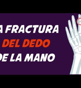 como saber si tengo un dedo fracturado de la mano