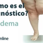 cómo saber si tienes lipedema