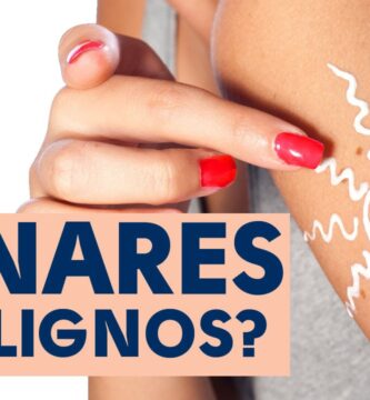 como saber si un lunar es maligno o benigno